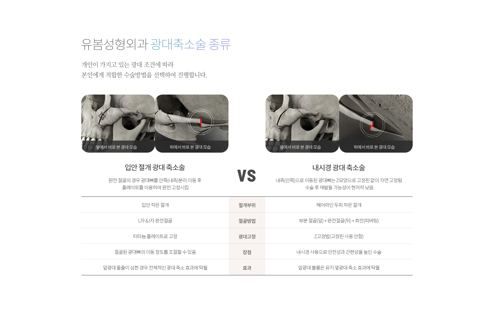 광대축소술 종류